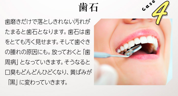 Case4歯石　歯磨きだけで落としきれない汚れがたまると歯石となります。歯石は歯をとても汚く見せます。そして歯ぐきの腫れの原因にも。放っておくと「歯周病」となっていきます。そうなると口臭もどんどんひどくなり、黄ばみが「黒」に変わっていきます。